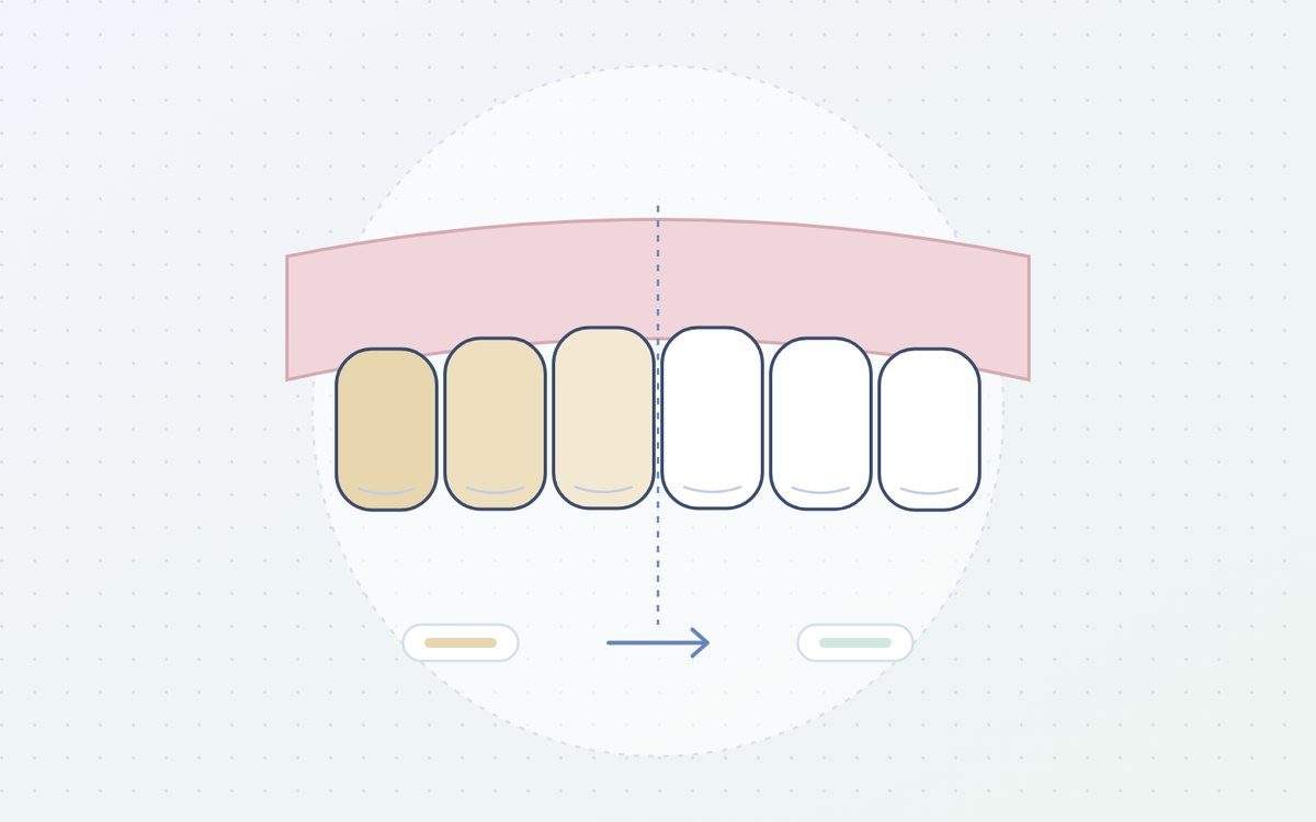 Ilustración: dientes antes y después de un blanqueamiento