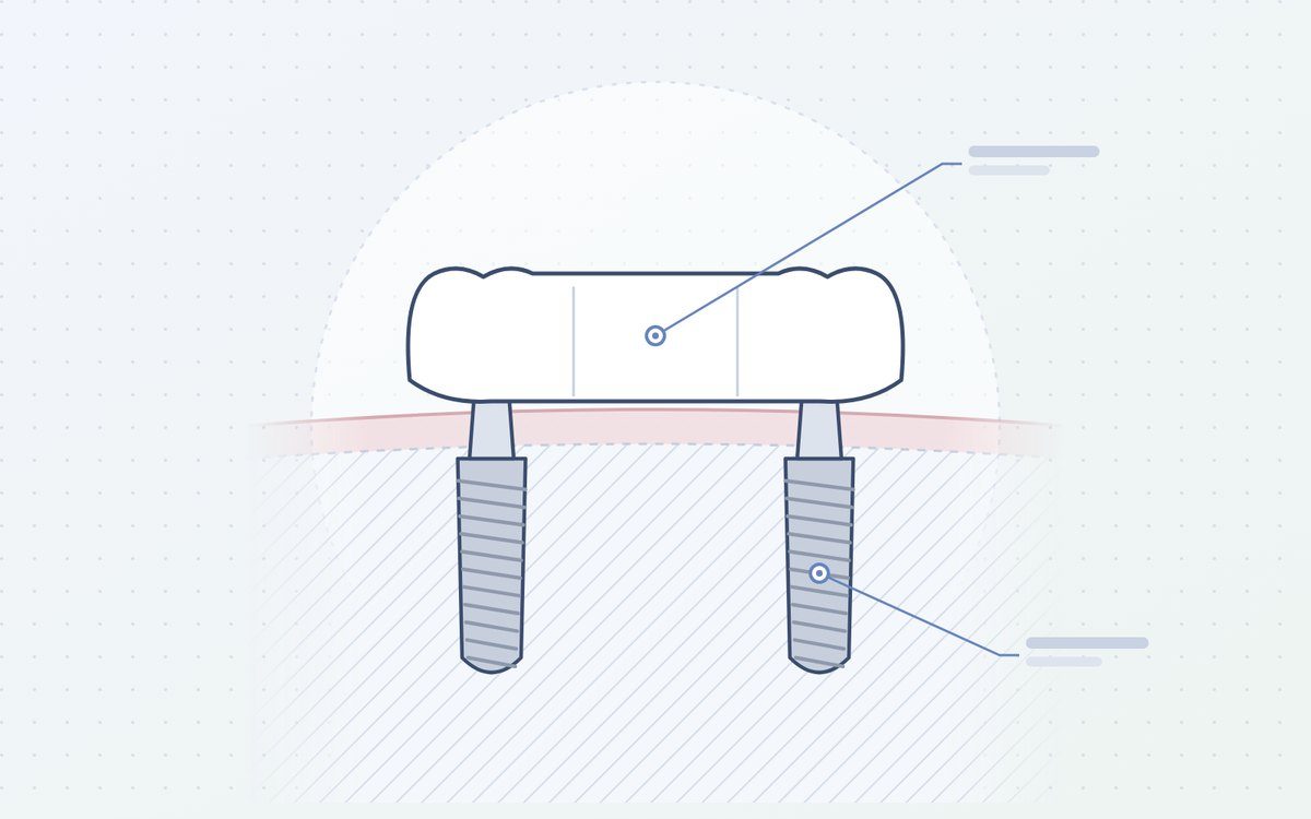 Ilustración: puente fijo sobre dos implantes