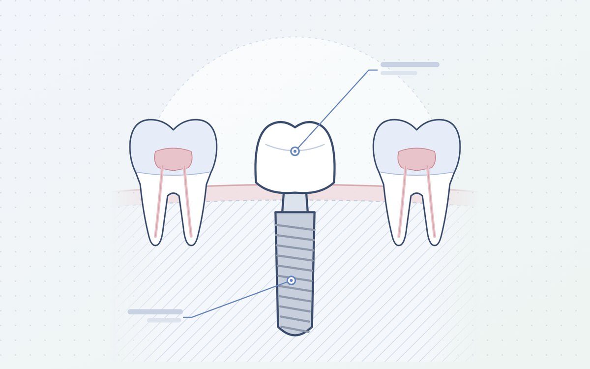 Ilustración: implante con corona entre dos dientes naturales