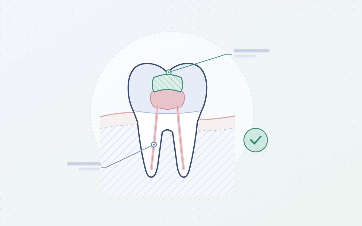 Ilustración: muela reparada con un empaste del color del diente