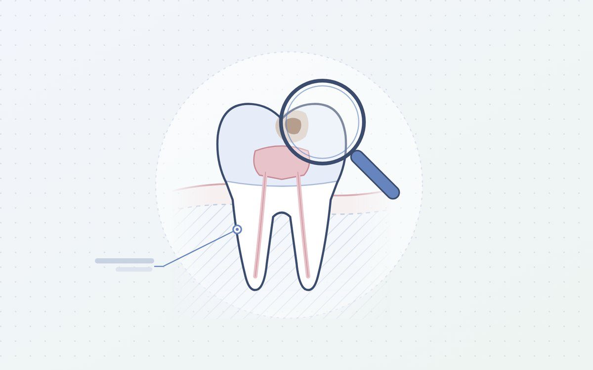 Ilustración: lupa sobre una caries en una muela