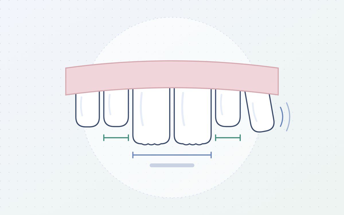 Ilustración: sonrisa infantil con dientes de leche y los primeros dientes definitivos, más grandes