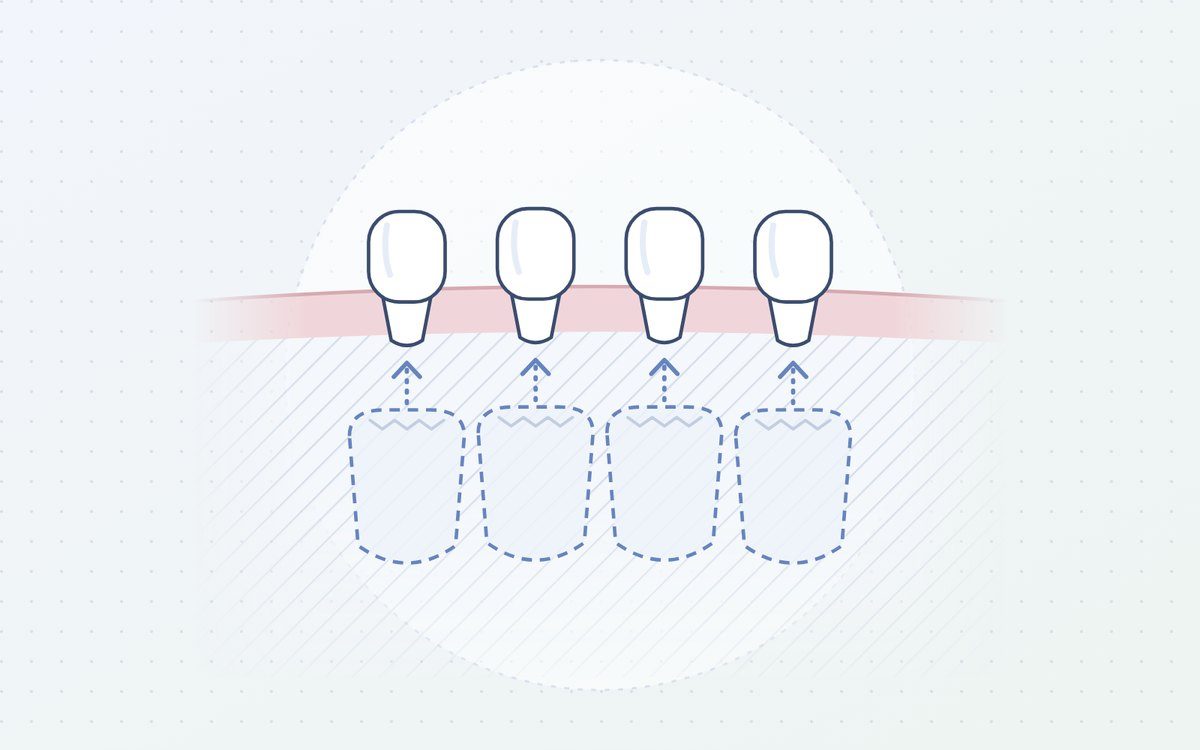 Ilustración: dientes de leche con los definitivos empujando desde abajo