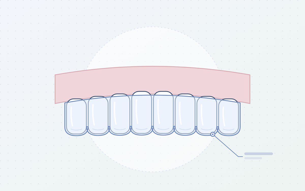 Ilustración: alineador transparente sobre los dientes