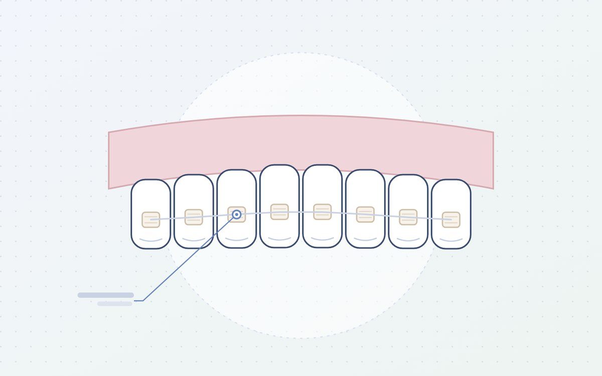 Ilustración: brackets cerámicos del color del diente