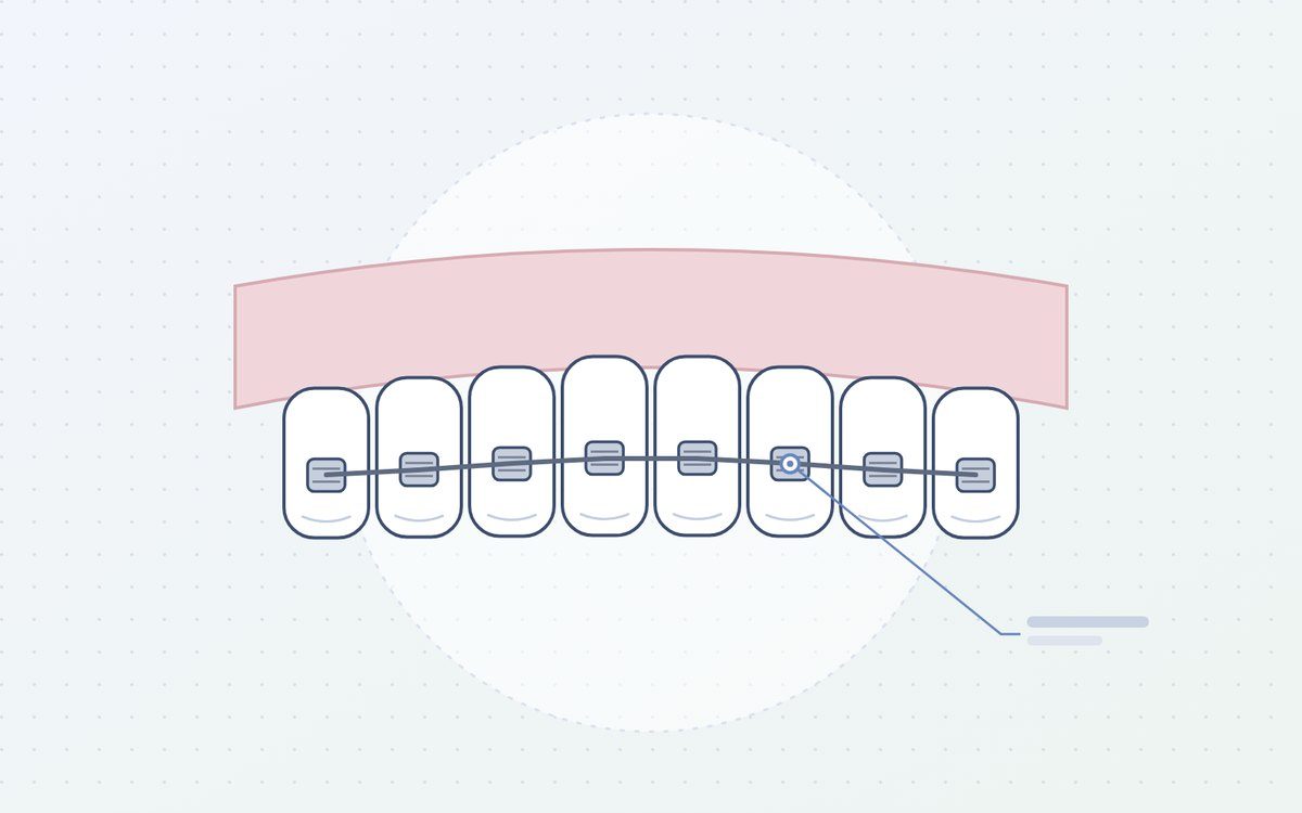 Ilustración: brackets metálicos sobre los dientes