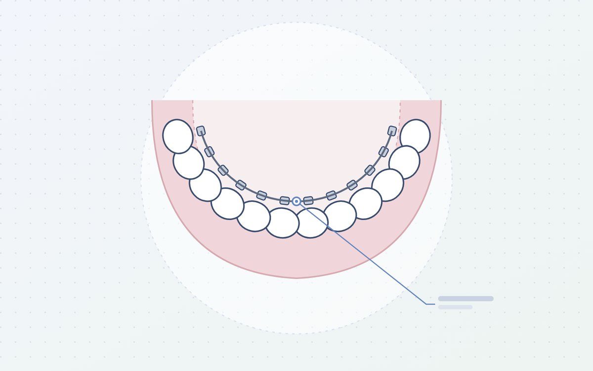 Ilustración: brackets colocados por la cara interna de los dientes