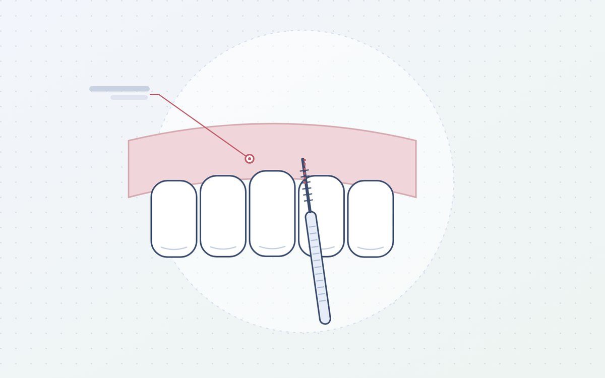Ilustración: sonda periodontal midiendo la encía