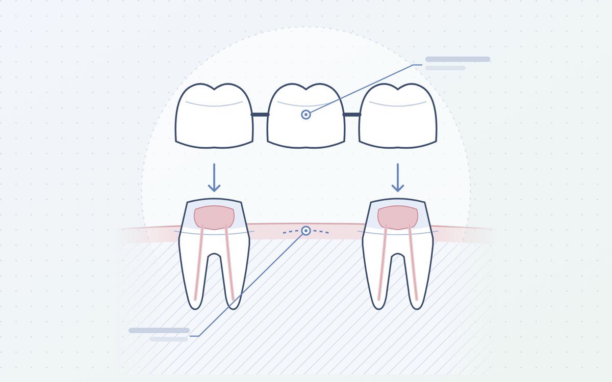 Ilustración: puente fijo de tres dientes sobre dos dientes tallados
